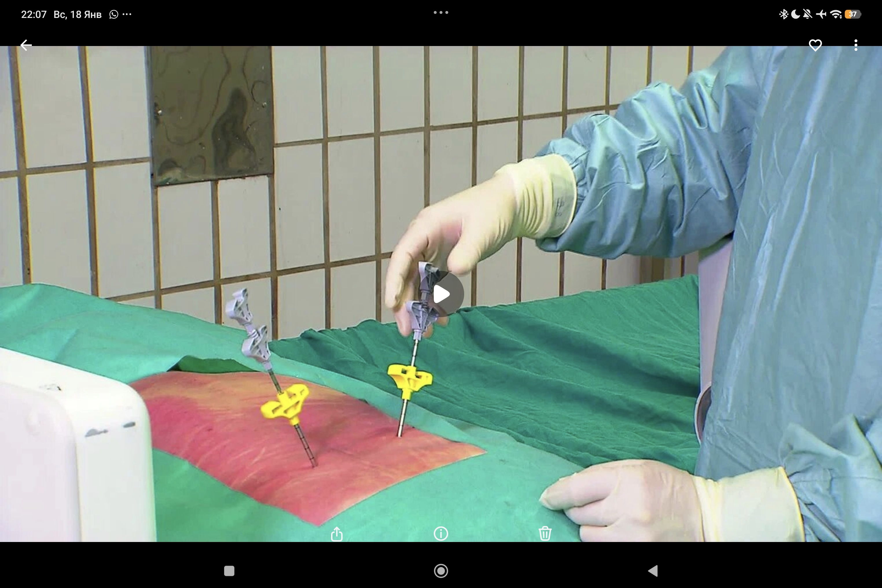 Joline 13: завершение кифопластики