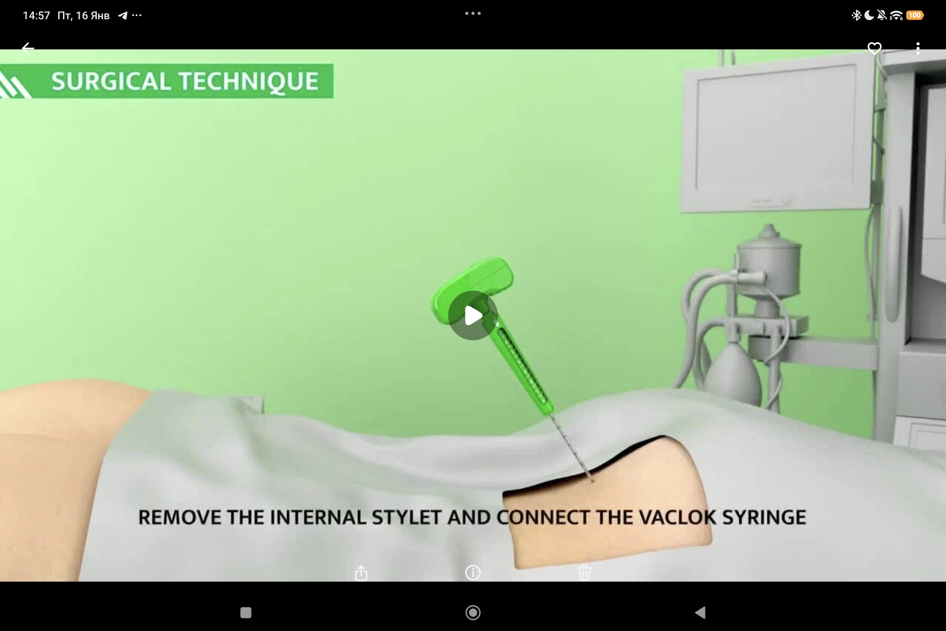 Marrow-Stem: хирургическая техника (анимация)