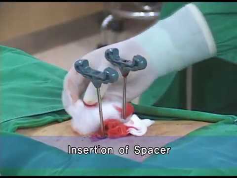 Операция баллонной кифопластики