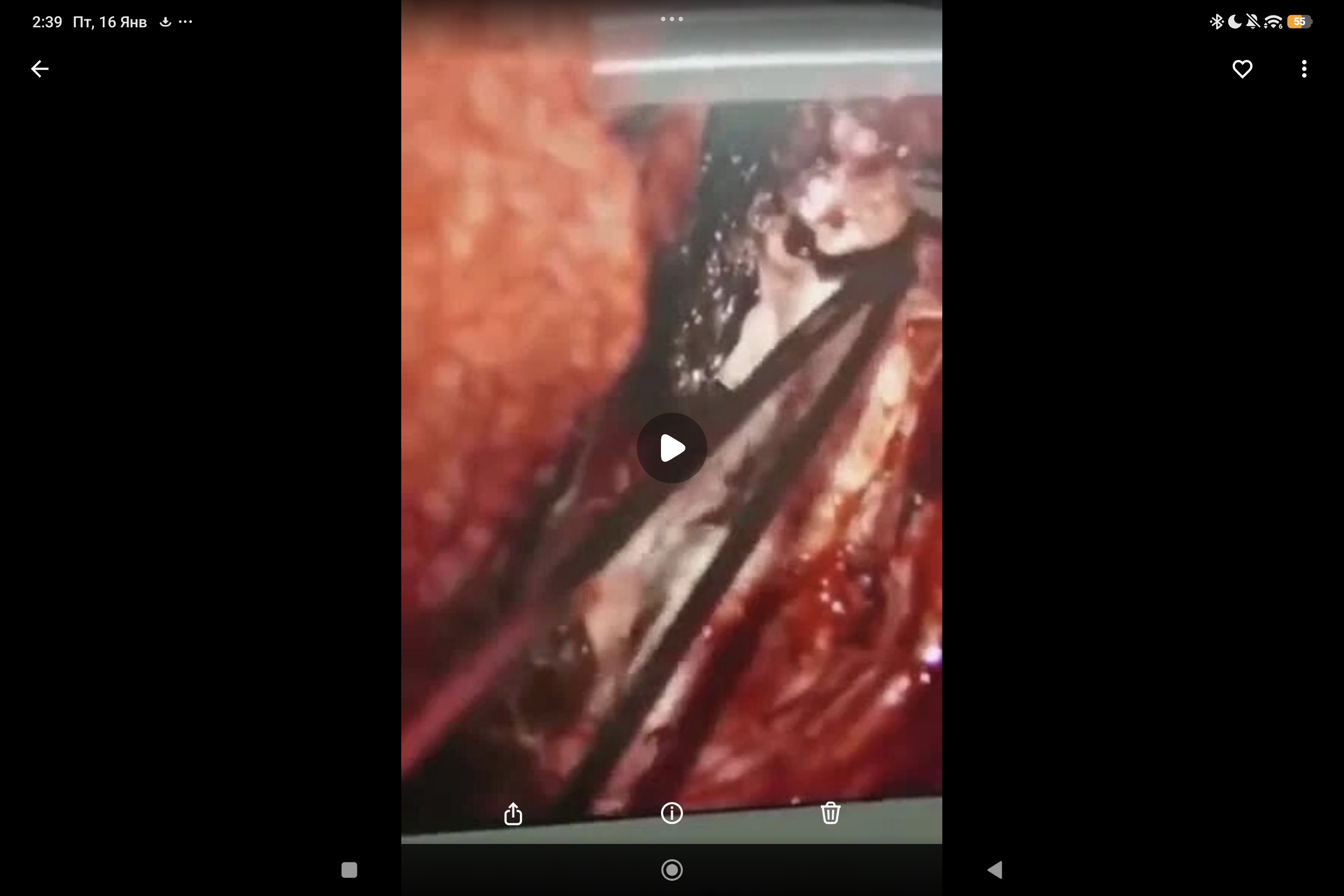 пластика дефекта ТМО после резекции опухоли с помощью заменителя ТМО нового поколения NeoDura