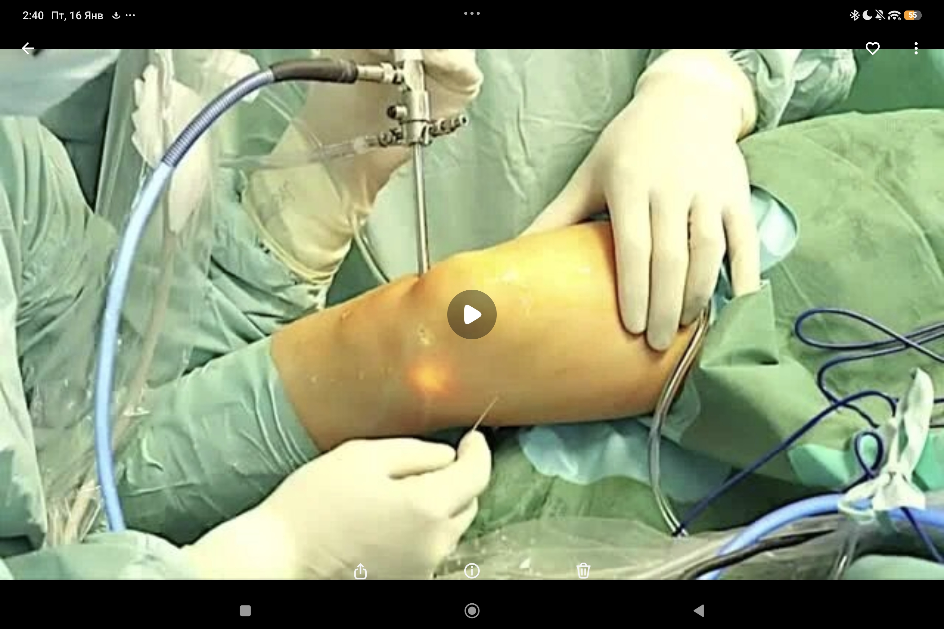 пластика мениска с помощью коллагеновой мембраны Chondro-Gide по методике AMMR