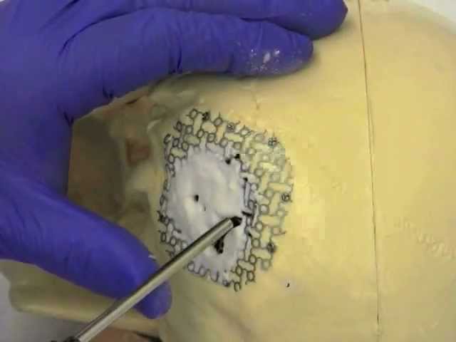 Комбинированная краниопластика с использованием титановой пластины и костного цемента