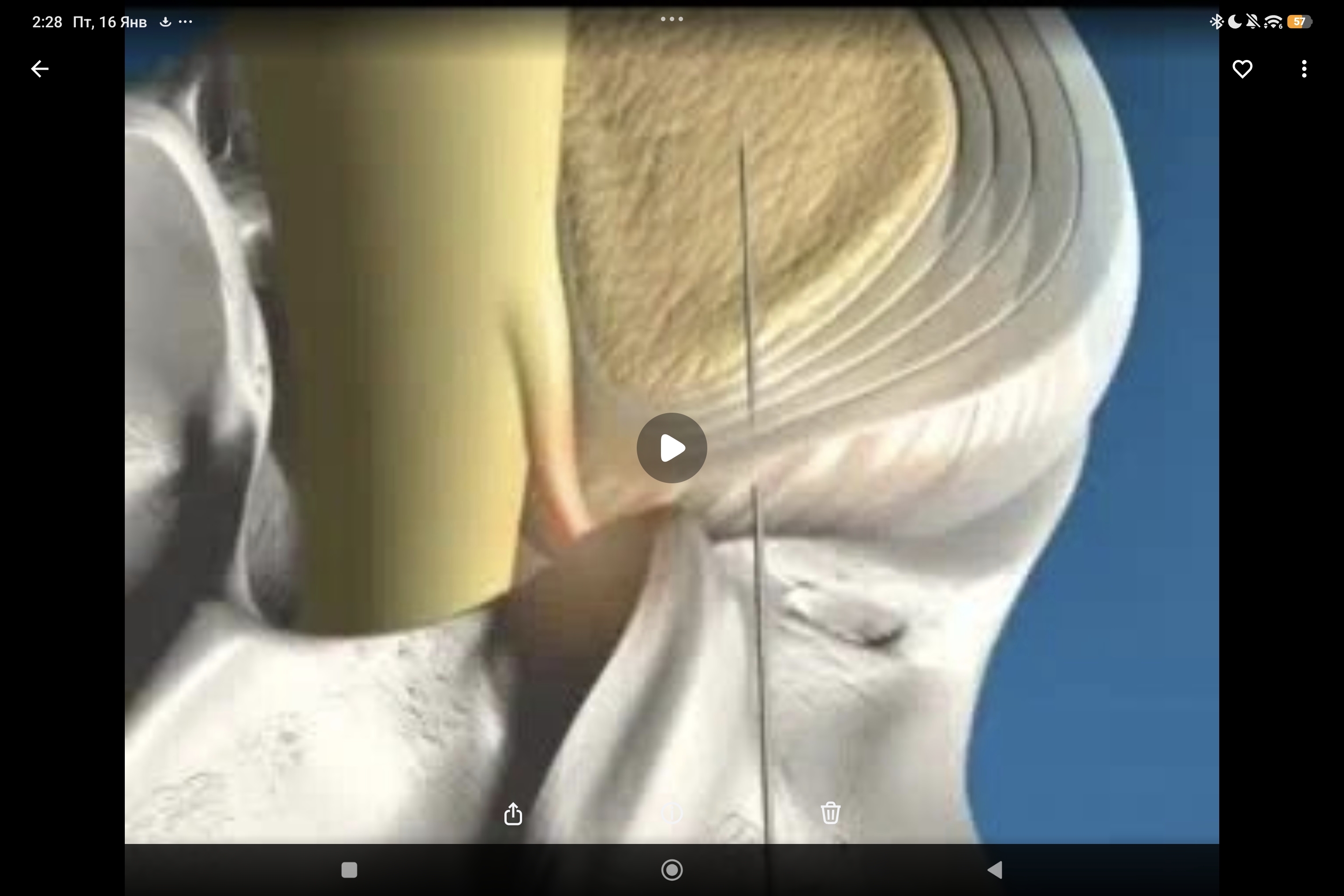 микродискэктомия при лечении грыжи позвоночника с помощью системы гидропластики SpineJet