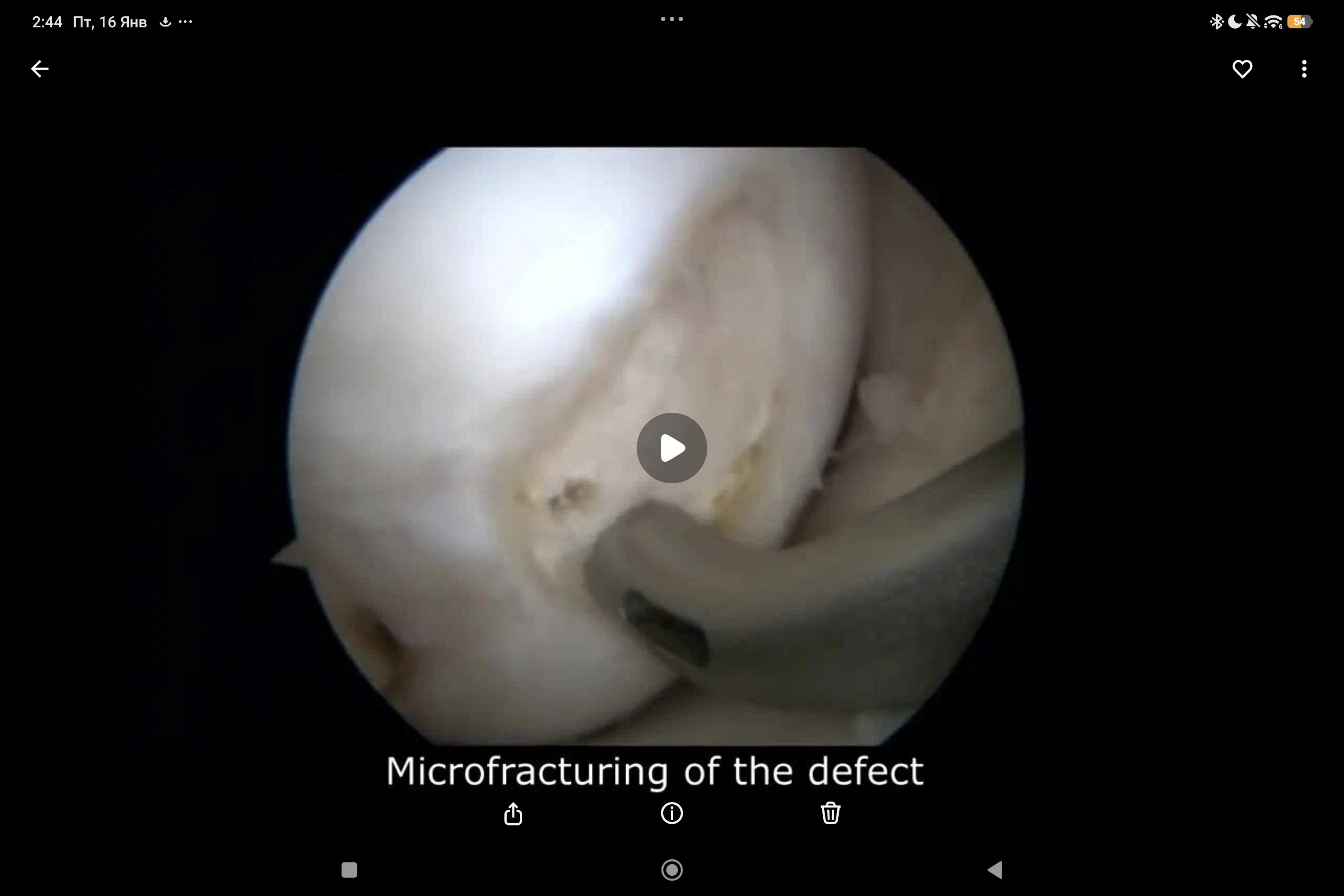 применение Vivostat PRF: хондропластика колена