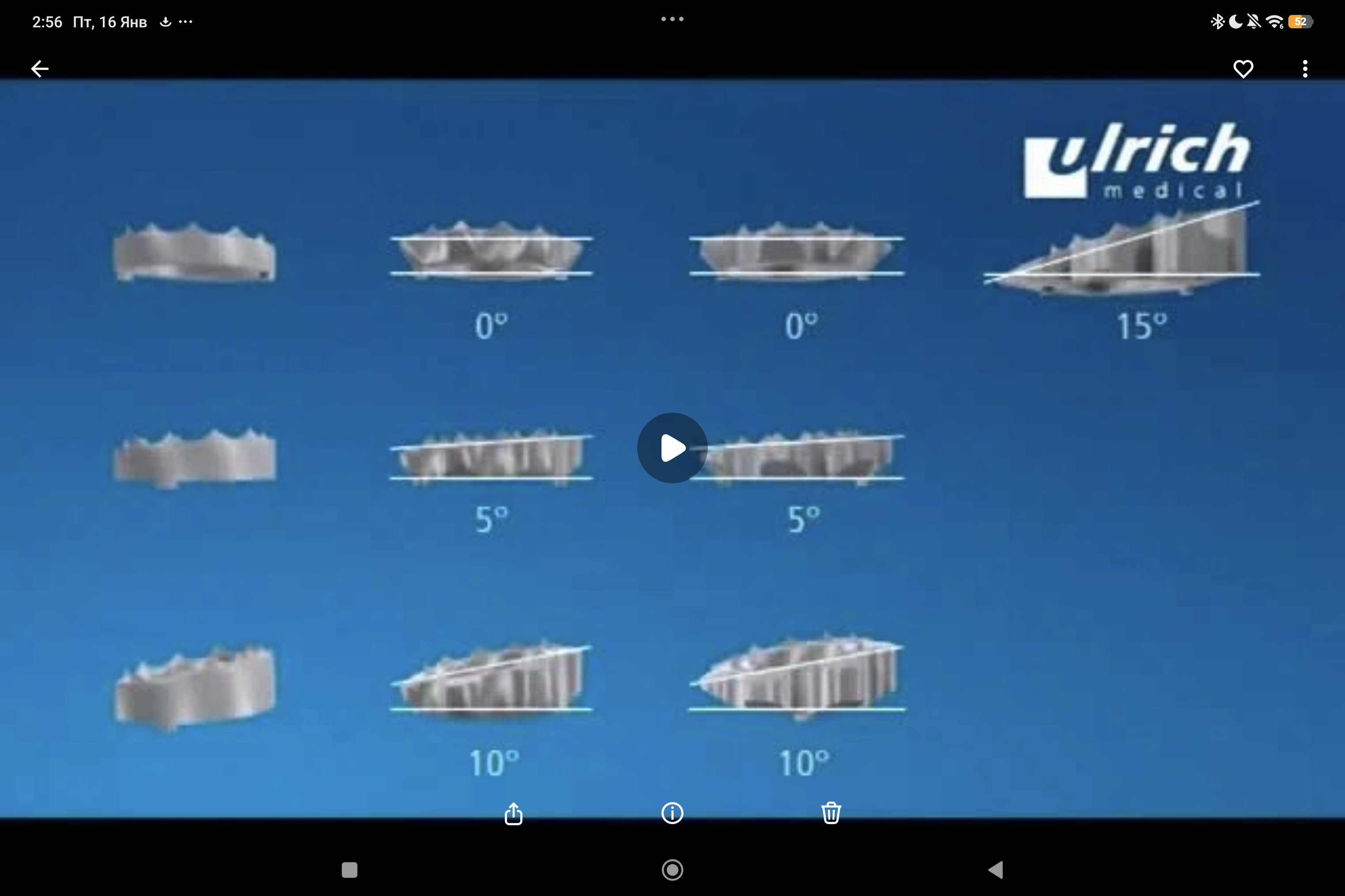 телескопический телозамещающий имплант Obelisc: техника операции