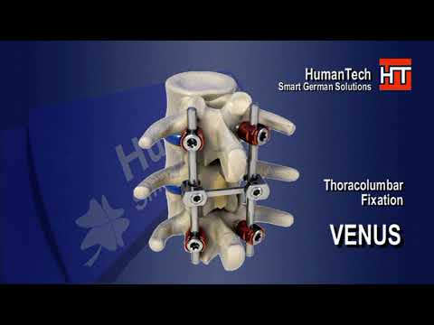 Видео презентация системы имплантов VENUS®