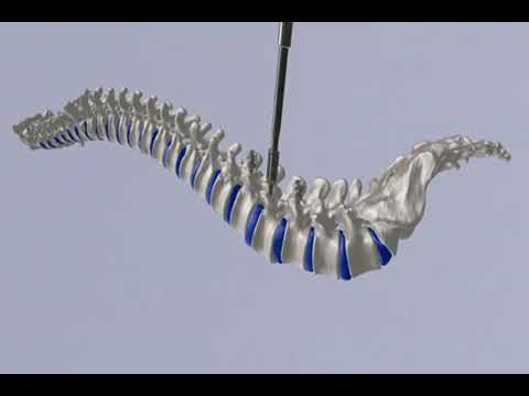 Устранение листеза