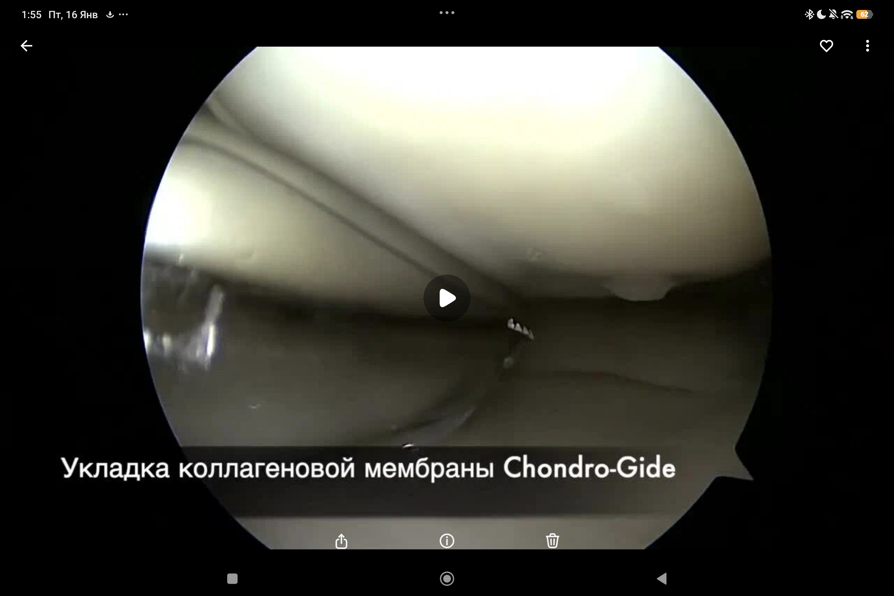 артроскопическая пластика мениска с матрицей Chondro-Gide (R)