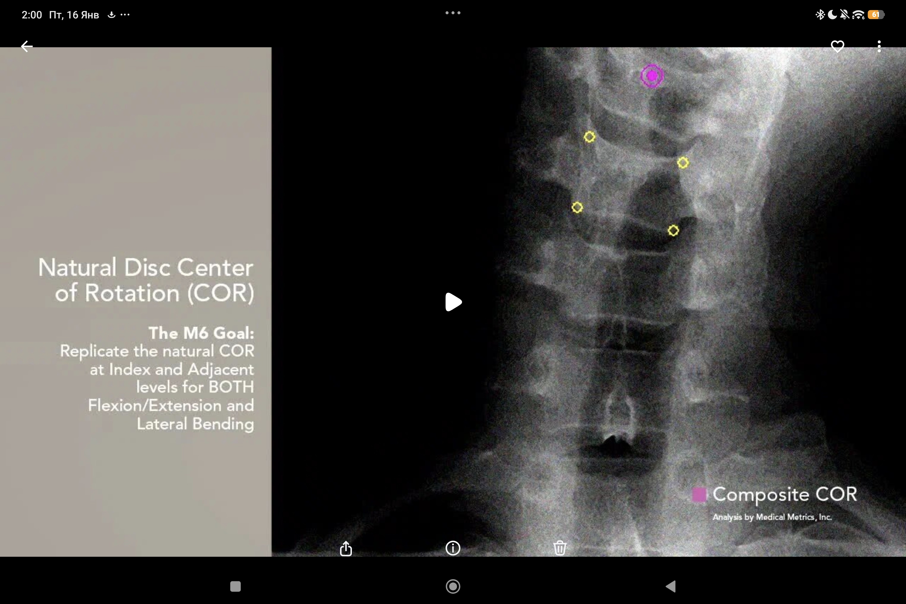 биомеханические исследования человеческого диска и эндопротеза M6