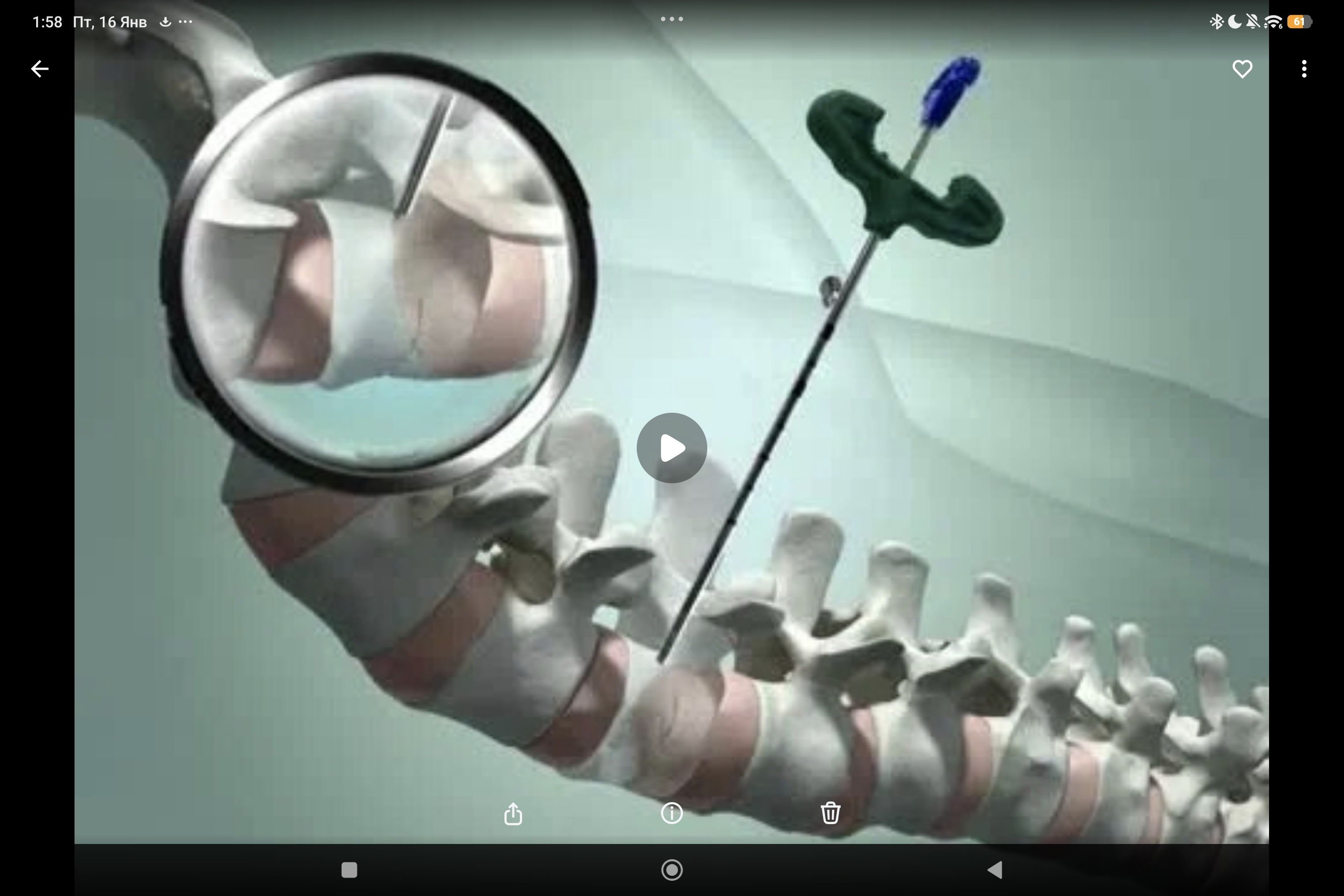 баллонная кифопластика Balex