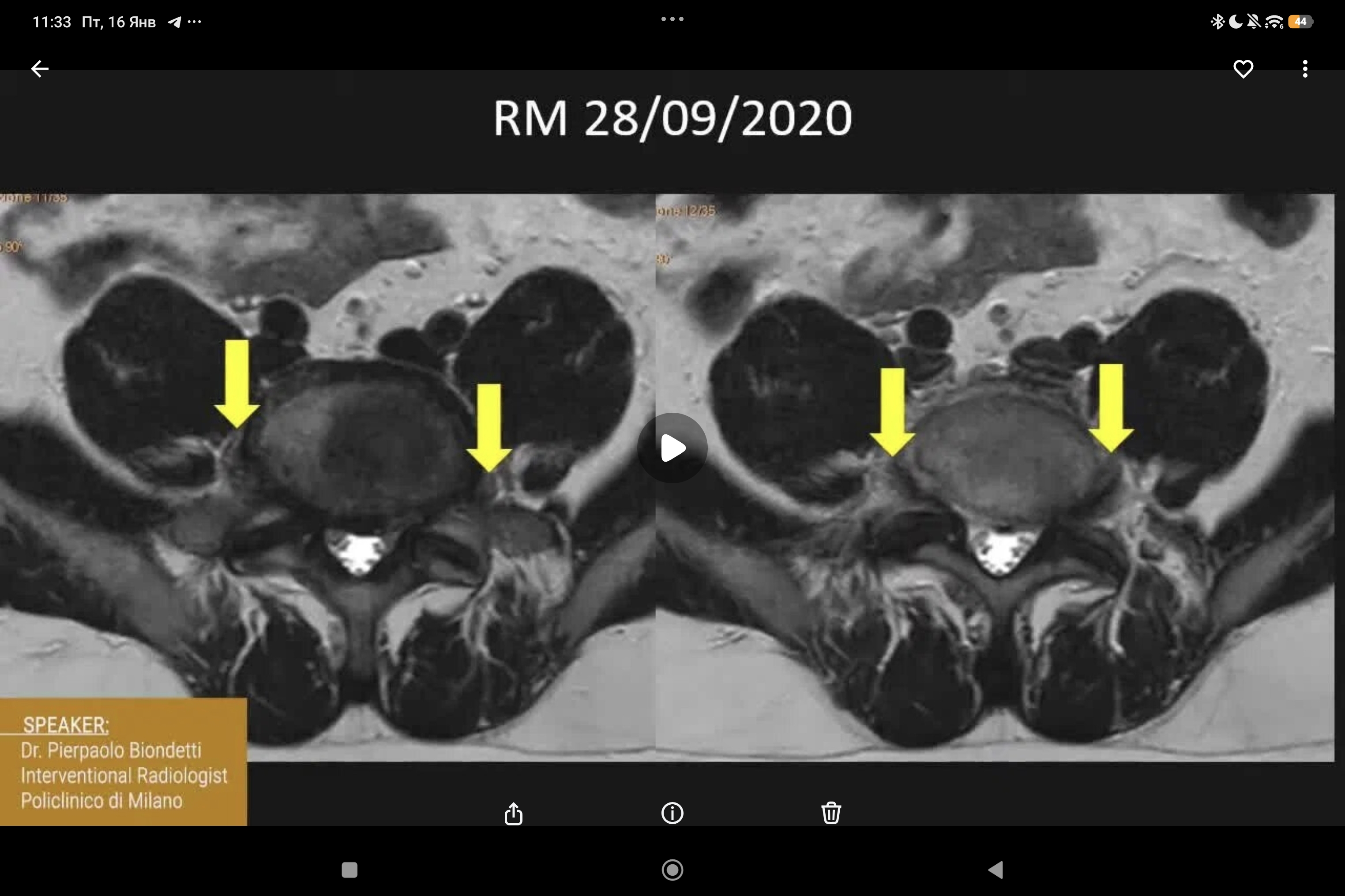 DISKOM: перкутанная дискэктомия на уровне L5-S1, вебинар и трансляция из операционной