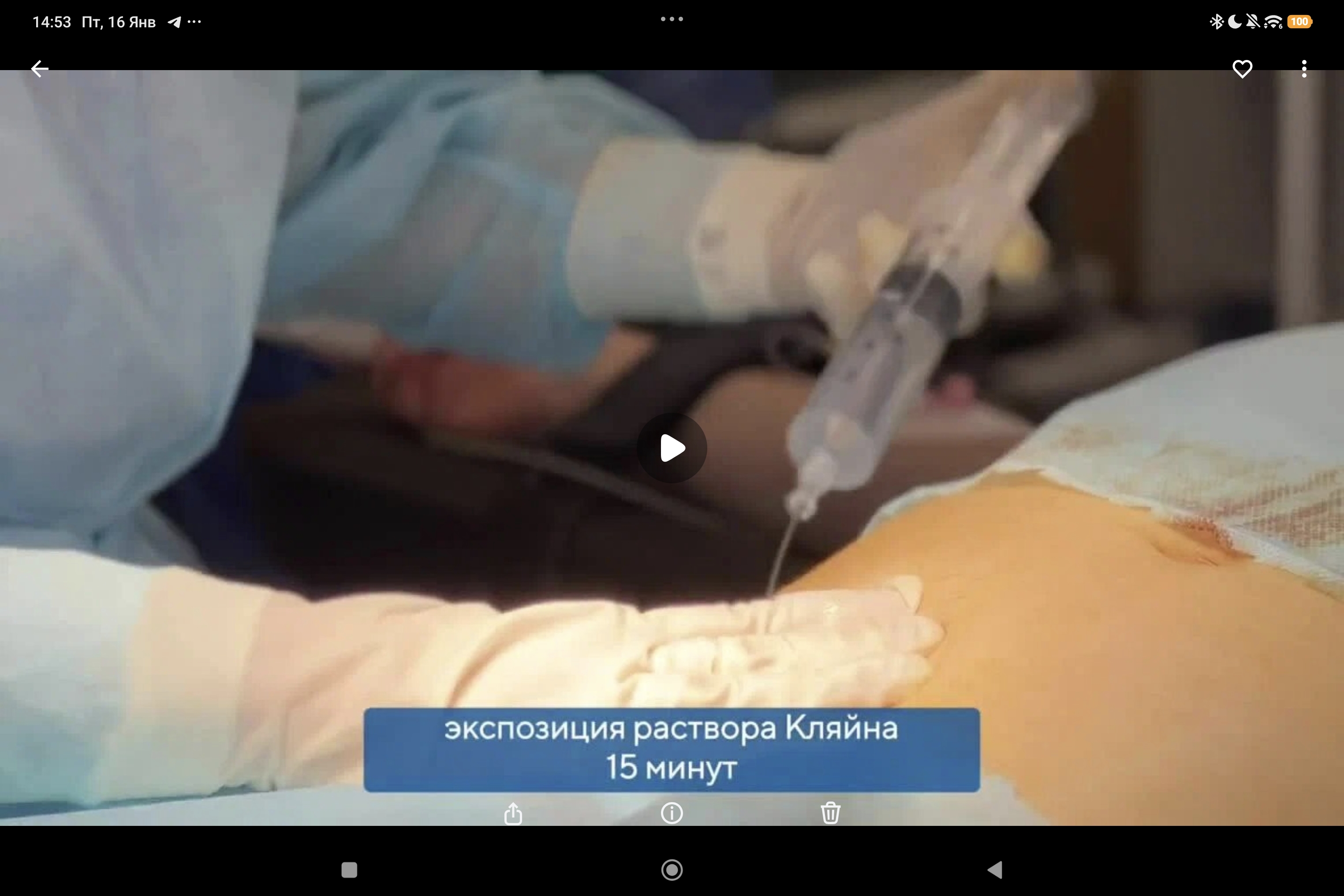 Lipo-Stem Duo: односторонний остеонекроз головки бедра