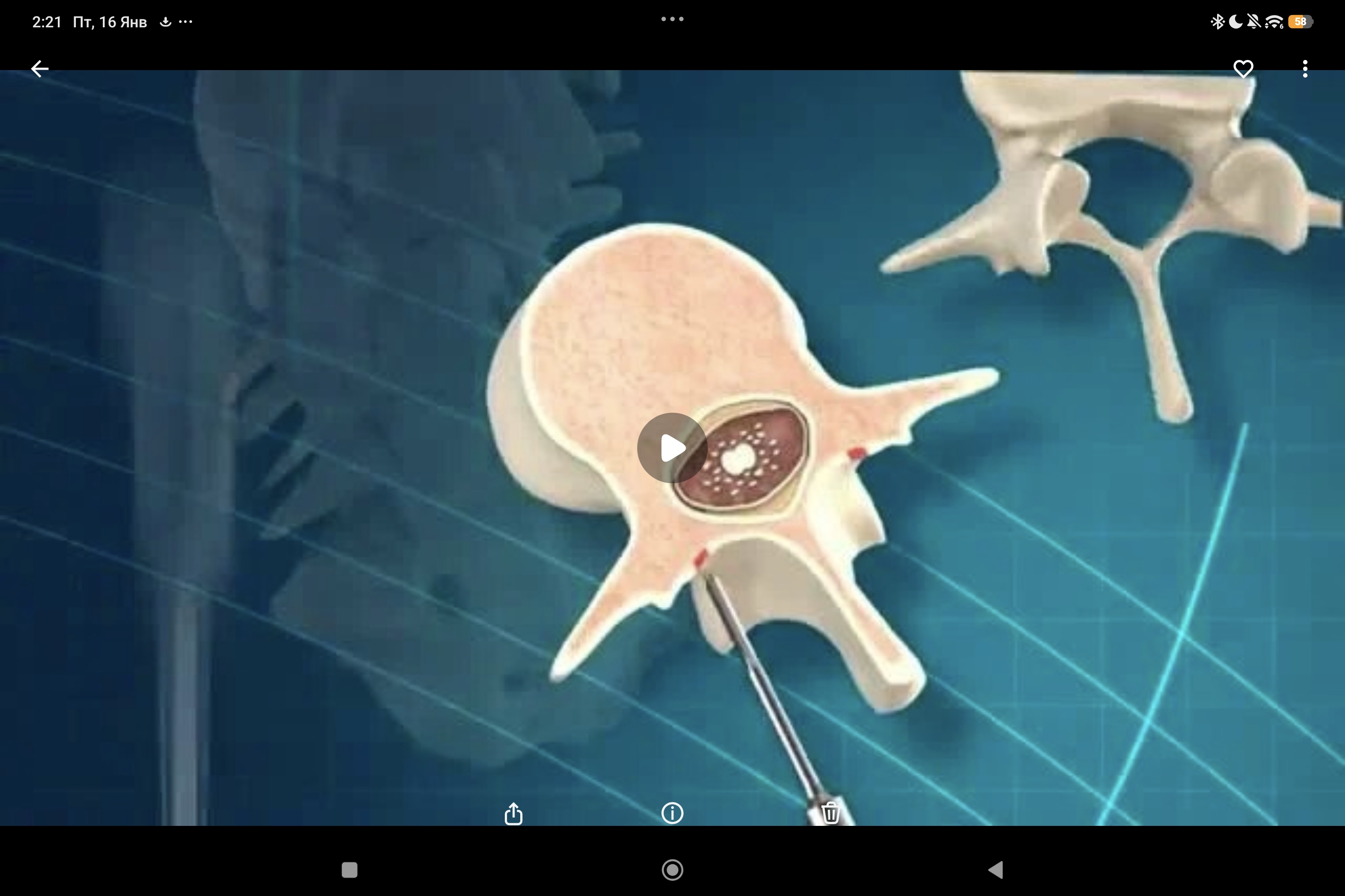 классический прямой PediGuard