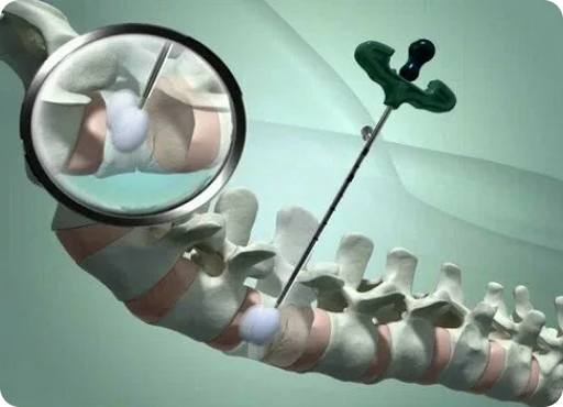 Эффективность кифопластики